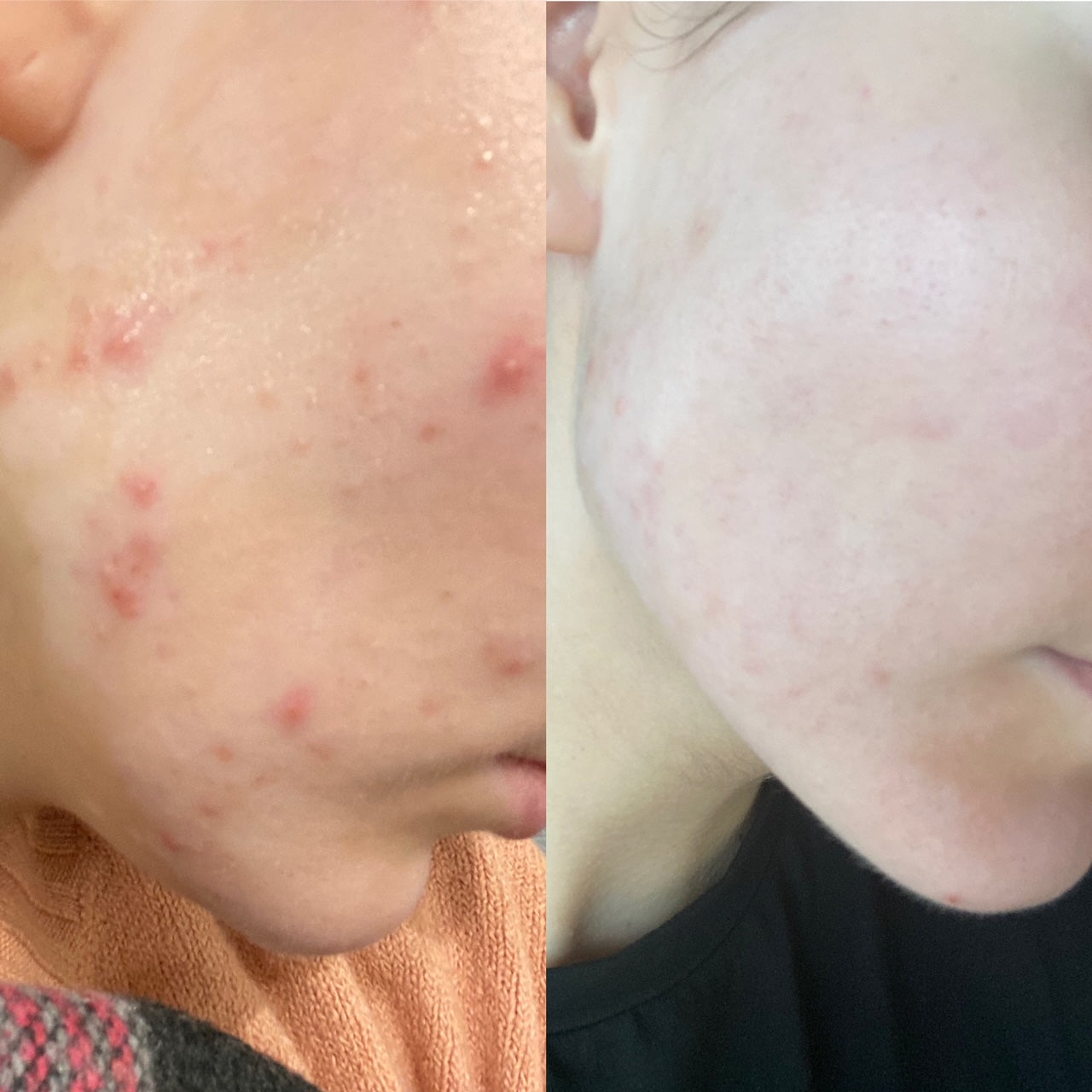 Matizuojantis serumas bėrimų prevencijai SKIN BALANCE